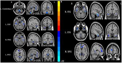 Abnormal regional signal in the left cerebellum as a potential neuroimaging biomarker of sudden sensorineural hearing loss